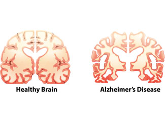 Returns – Alzheimer's Disease DNA