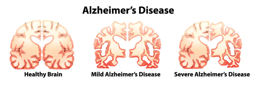 What are the stages of Alzheimer’s Disease? – Alzheimer's Disease DNA